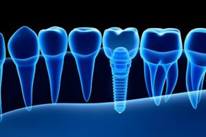 Could Dental Implants Help Your Smile?