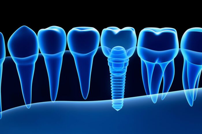 dental implants in Buford, GA