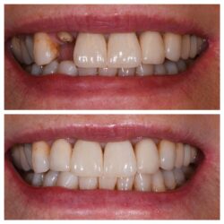 dental implants in buford, ga