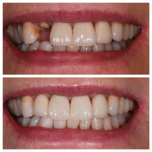 Dental Implants for damaged teeth before and after