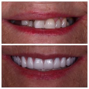 Implant-supported fixed denture before and after