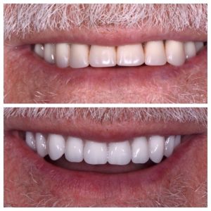 Replace old dentures with Implant-supported fixed dentures