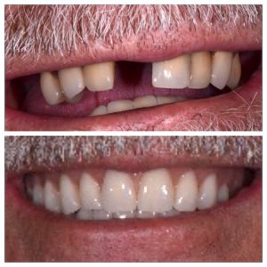 Implant-supported dentures in Buford GA Before and after