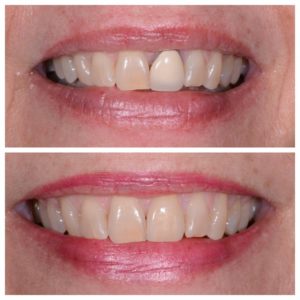 dental crown replacement in Buford GA before and after