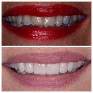 Dental crowns and veneers before and after in Buford GA