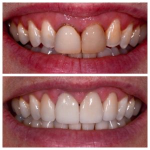 Before and after gum lift in Buford GA