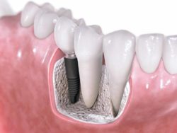Dental implant to replace missing teeth in Buford GA