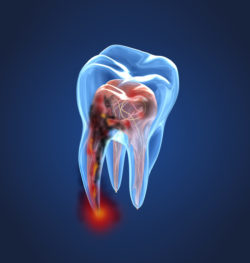 Painless root canal treatment in Buford, Georgia