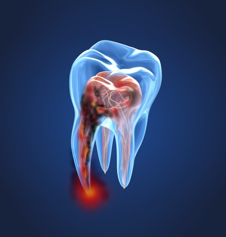Root Canal Buford GA What is a Root Canal Procedure