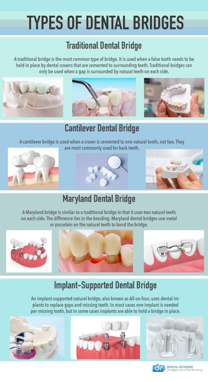 Types of Dental Bridges Buford, GA