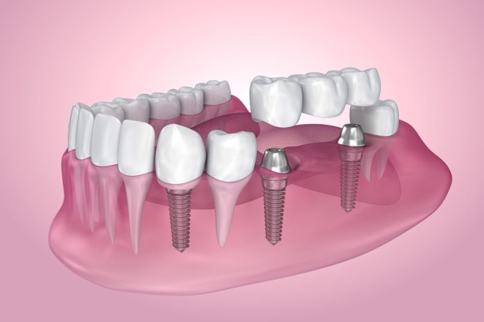 types of dental implants in Buford Georgia