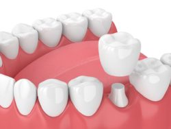 dental crown benefits in Buford Georgia
