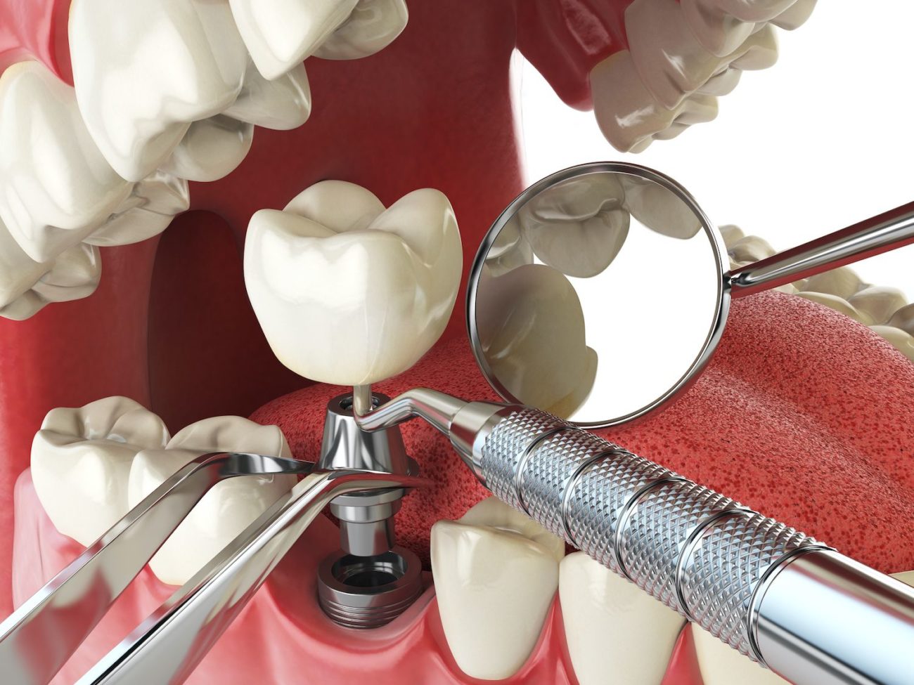 dental implant surgery Buford Georgia