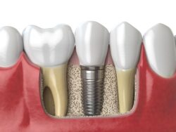 Tooth Replacement After Gum Disease