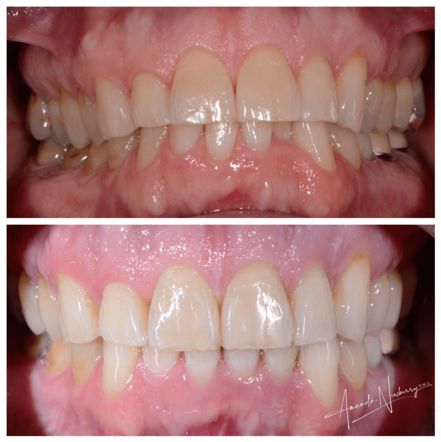 Main Gallery Image 3 | Invisalign Cases
