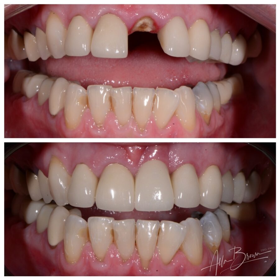 Main Gallery Image 5 | Dental Implant Cases