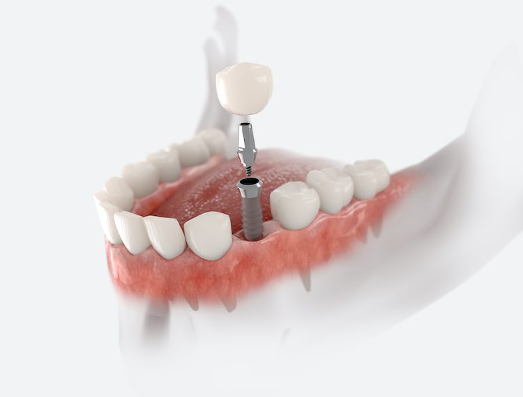 Understanding the various financial options available can make dental implants more accessible for patients.