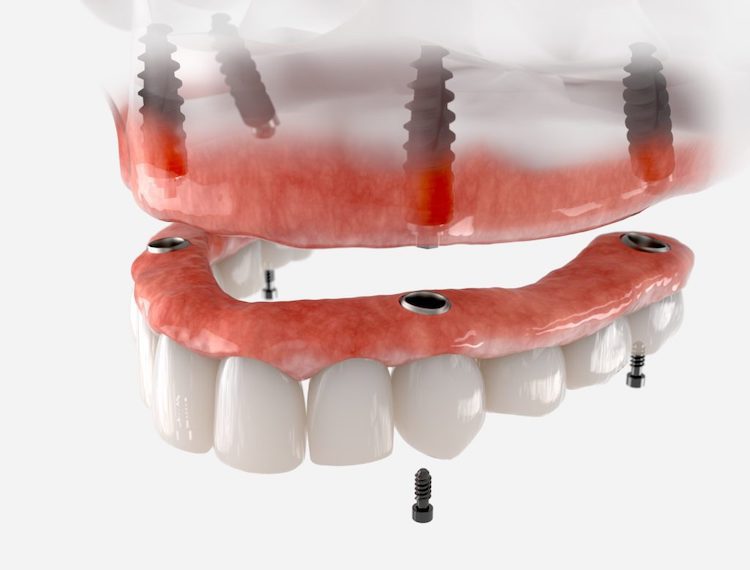 Understanding the differences between dental implants and dentures can help you make an informed decision about your oral health.